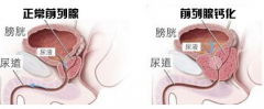 前列腺钙化有哪些症状