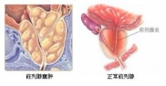 前列腺囊肿患者要做哪些检查?